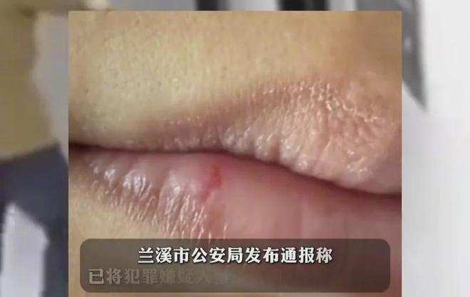 被醉汉强吻女子称：不敢睡觉一天刷牙十几次害怕男人有传染病(图6)